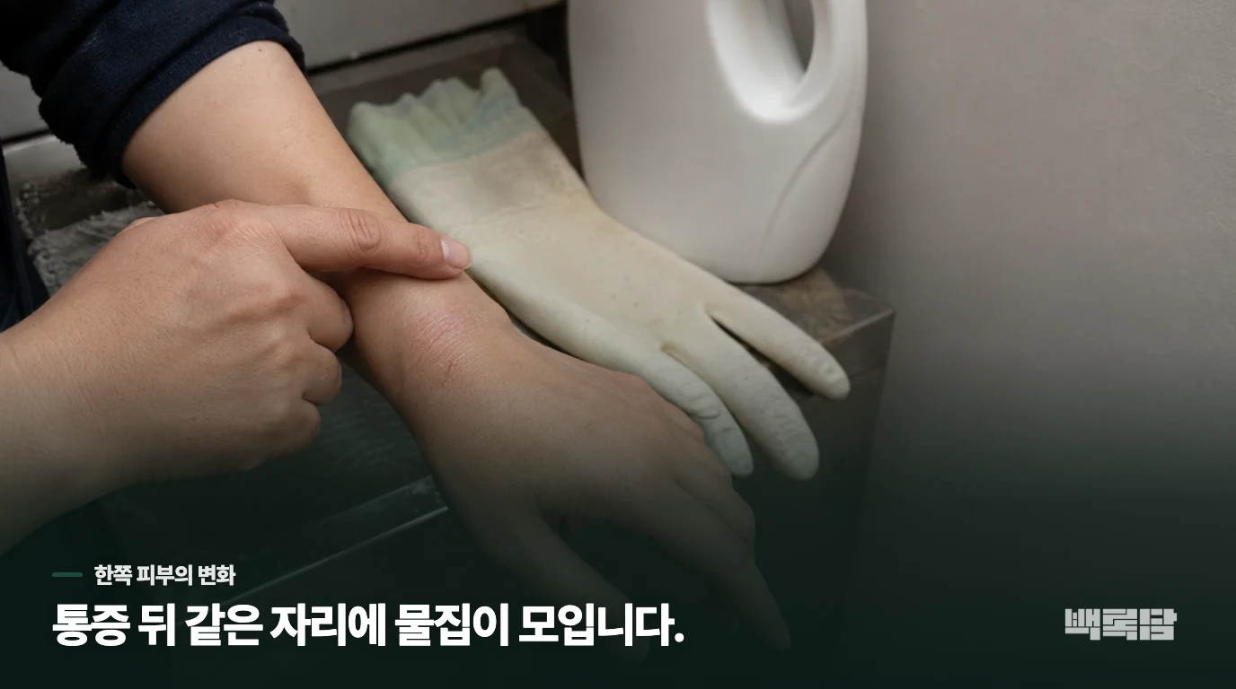 통증이 먼저 오고 한쪽에 물집이 모이면 대상포진을 의심합니다
