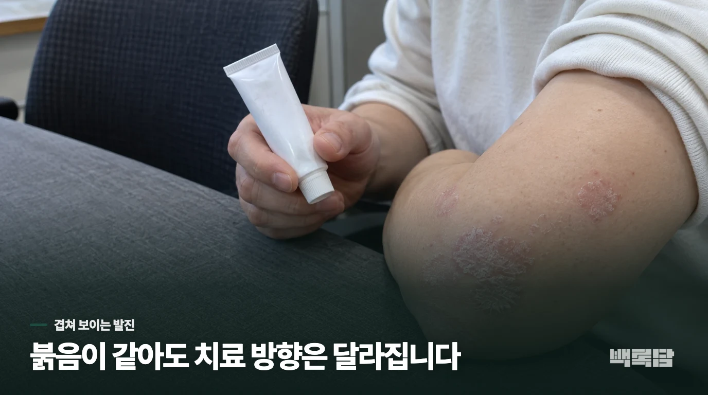 건선과 피부염·곰팡이 감염은 어떻게 나눌까요?