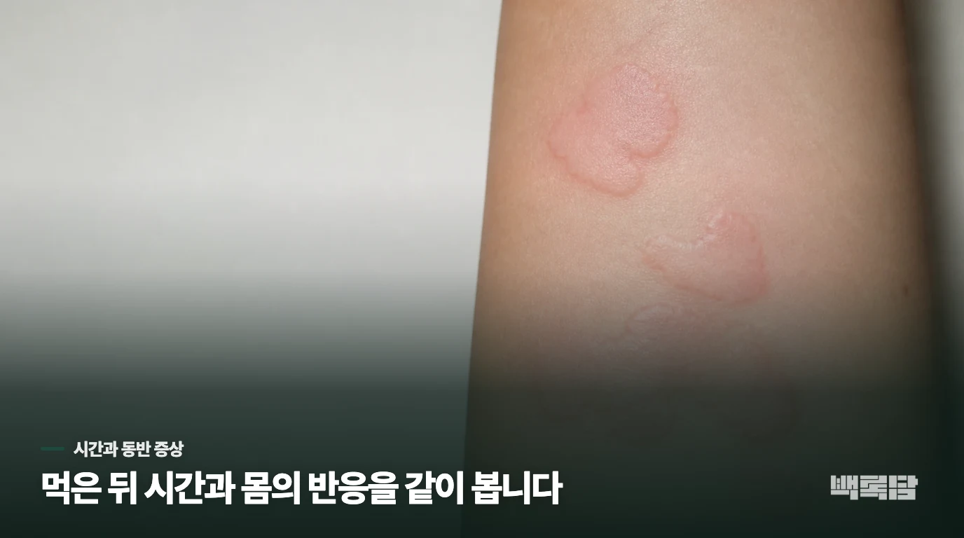 음식 알레르기를 의심할 때는 시간과 동반 증상을 봅니다