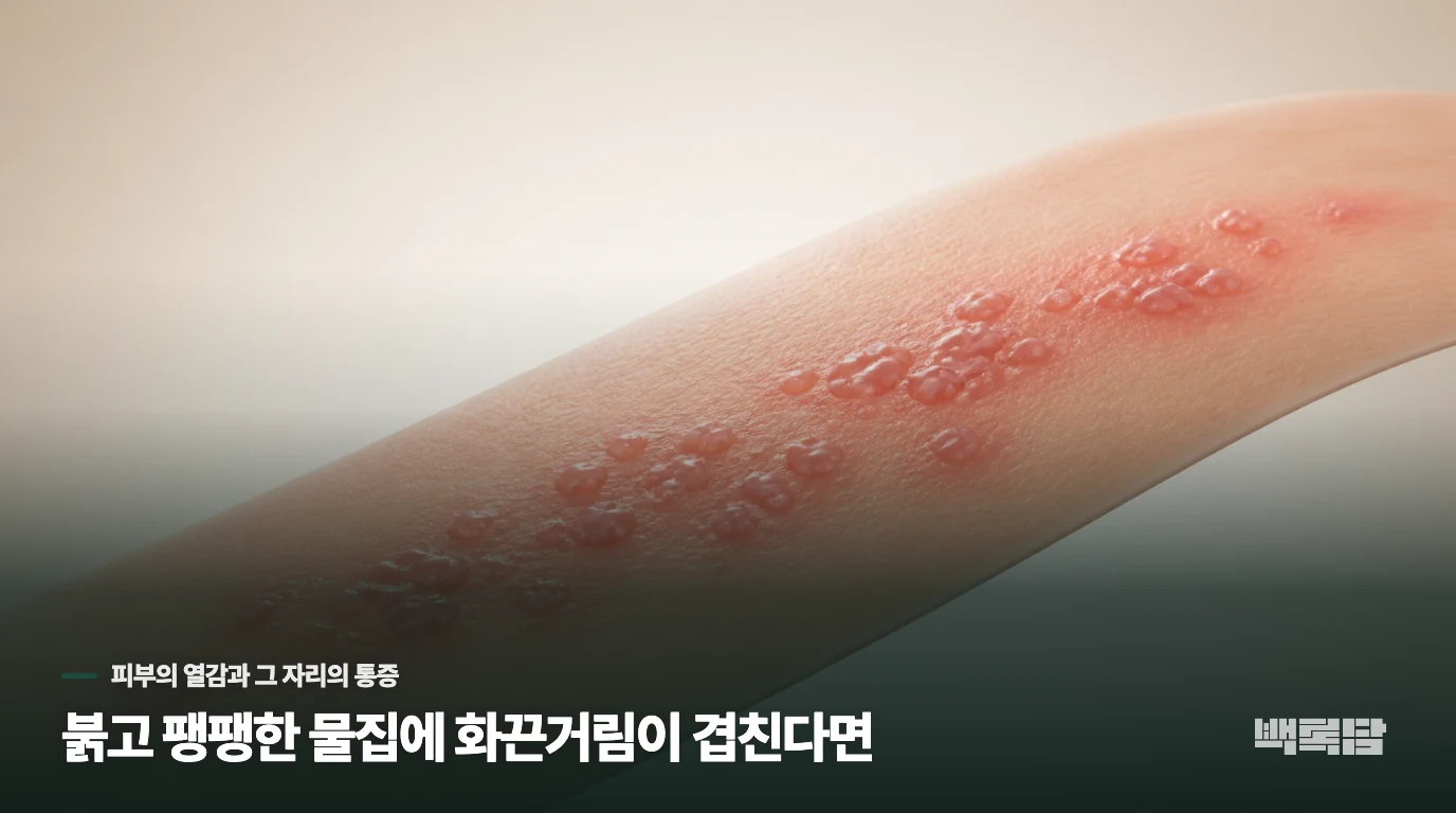 붉고 팽팽한 물집에 화끈거림이 겹친다면