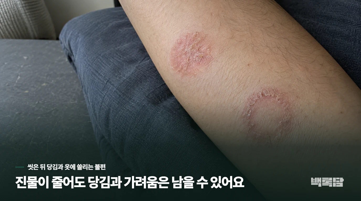 진물이 줄어도 당김과 가려움은 남을 수 있어요